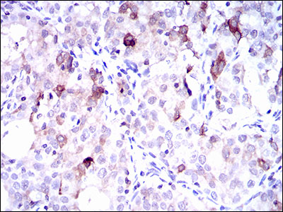 SLC27A5 / BACS Antibody - IHC of paraffin-embedded cervical cancer tissues using SLC27A5 mouse monoclonal antibody with DAB staining.