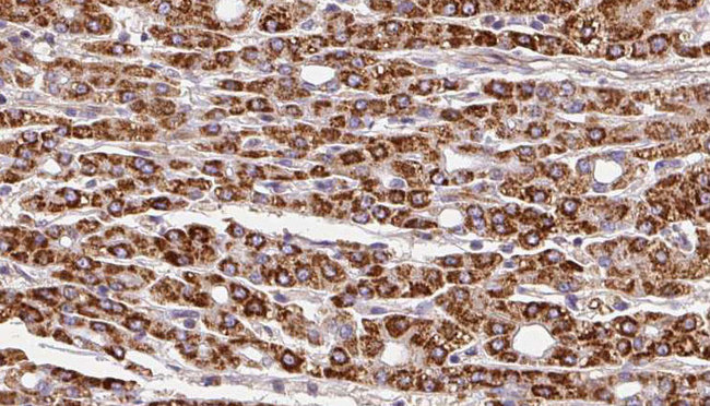 SLC28A1 Antibody - 1:100 staining human liver carcinoma tissues by IHC-P. The sample was formaldehyde fixed and a heat mediated antigen retrieval step in citrate buffer was performed. The sample was then blocked and incubated with the antibody for 1.5 hours at 22°C. An HRP conjugated goat anti-rabbit antibody was used as the secondary.