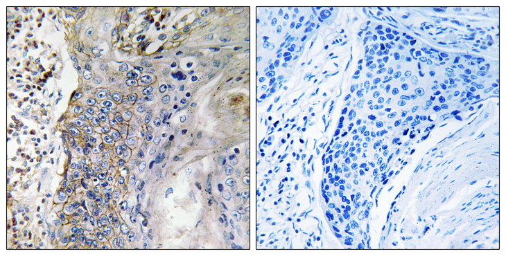 SLC28A2 Antibody - Immunohistochemistry analysis of paraffin-embedded human lung carcinoma tissue, using SLC28A2 Antibody. The picture on the right is blocked with the synthesized peptide.