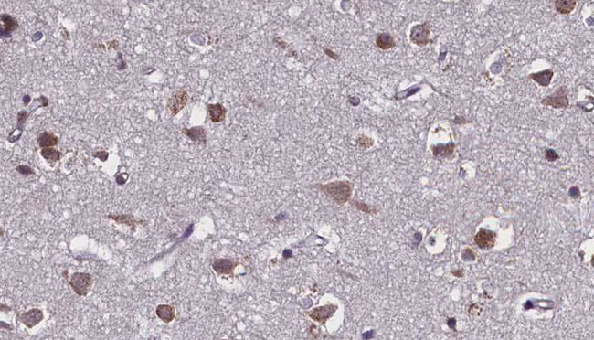 SLC28A2 Antibody - 1:100 staining human brain carcinoma tissue by IHC-P. The sample was formaldehyde fixed and a heat mediated antigen retrieval step in citrate buffer was performed. The sample was then blocked and incubated with the antibody for 1.5 hours at 22°C. An HRP conjugated goat anti-rabbit antibody was used as the secondary.