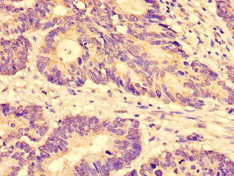 SLC28A3 Antibody - Immunohistochemistry of paraffin-embedded human colon cancer using SLC28A3 Antibody at dilution of 1:100