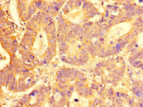 SLC29A1 / ENT1 Antibody - Immunohistochemistry of paraffin-embedded human colon cancer tissue using SLC29A1 Antibody at dilution of 1:100