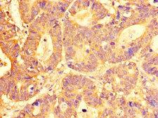 SLC29A1 / ENT1 Antibody - Immunohistochemistry of paraffin-embedded human colon cancer tissue using SLC29A1 Antibody at dilution of 1:100