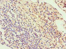 SLC2A1 / GLUT-1 Antibody - Immunohistochemistry of paraffin-embedded human cervical cancer using antibody at 1:100 dilution.