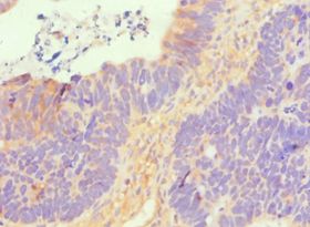 SLC2A1 / GLUT-1 Antibody - Immunohistochemistry of paraffin-embedded human ovarian cancer using antibody at 1:100 dilution.