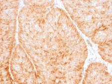 SLC2A1 / GLUT-1 Antibody - IHC testing of human bladder carcinoma with GLUT1 antibody (clone GLUT1/2475). Required HIER: boil tissue sections in 10mM citrate buffer, pH 6, for 10-20 min followed by cooling at RT for 20 min.