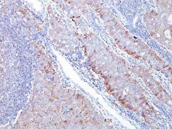 SLC2A1 / GLUT-1 Antibody - IHC testing of human breast carcinoma with GLUT1 antibody (clone GLUT1/2476). Required HIER: boil tissue sections in 10mM citrate buffer, pH 6, for 10-20 min followed by cooling at RT for 20 min.