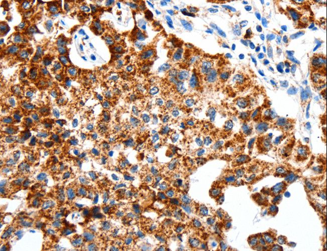 SLC2A1 / GLUT-1 Antibody - Immunohistochemistry of paraffin-embedded Human lung cancer using SLC2A1 Polyclonal Antibody at dilution of 1:50.