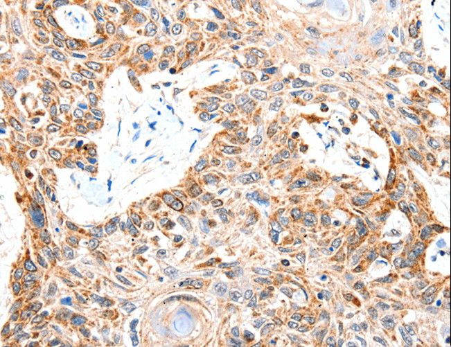 SLC2A1 / GLUT-1 Antibody - Immunohistochemistry of paraffin-embedded Human esophagus cancer using SLC2A1 Polyclonal Antibody at dilution of 1:50.