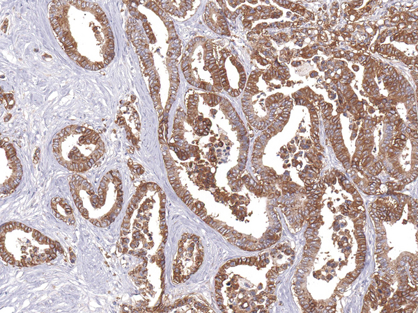 SLC2A1 / GLUT-1 Antibody - GLUT1 on Colon Cancer