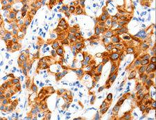 SLC2A11 / GLUT11 Antibody - Immunohistochemistry of paraffin-embedded Human cervical cancer using SLC2A11 Polyclonal Antibody at dilution of 1:140.