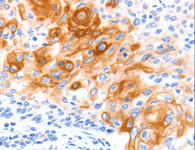 SLC2A11 / GLUT11 Antibody - Immunohistochemistry of paraffin-embedded Human cervical cancer using SLC2A11 Polyclonal Antibody at dilution of 1:140.