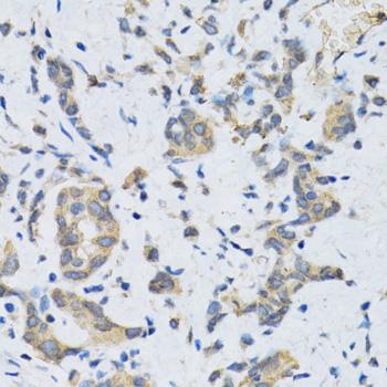SLC2A13 / HMIT / GLUT13 Antibody - Immunohistochemistry of paraffin-embedded Human gastric cancer using SLC2A13 Polyclonal Antibody at dilution of 1:100 (40x lens).