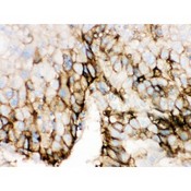 SLC2A2 / GLUT2 Antibody - SLC2A2 antibody IHC-paraffin. IHC(P): Human Liver Cancer Tissue.