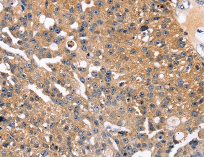SLC2A2 / GLUT2 Antibody - Immunohistochemistry of paraffin-embedded Human esophagus cancer using SLC2A2 Polyclonal Antibody at dilution of 1:35.