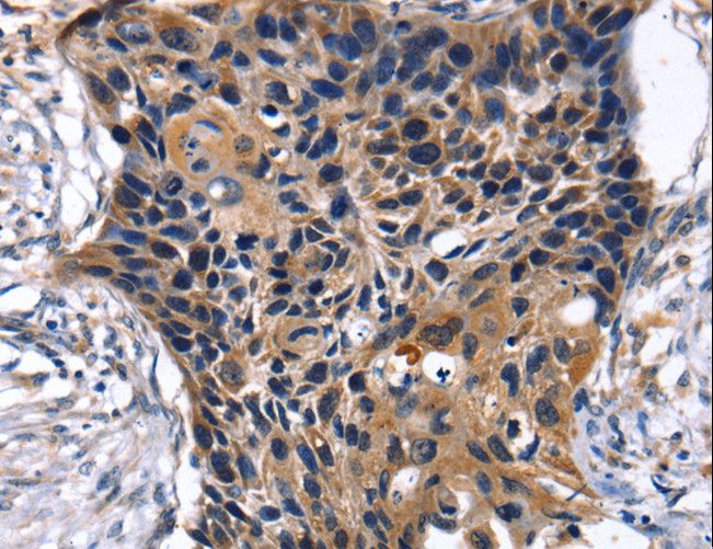 SLC2A2 / GLUT2 Antibody - Immunohistochemistry of paraffin-embedded Human esophagus cancer using SLC2A2 Polyclonal Antibody at dilution of 1:35.