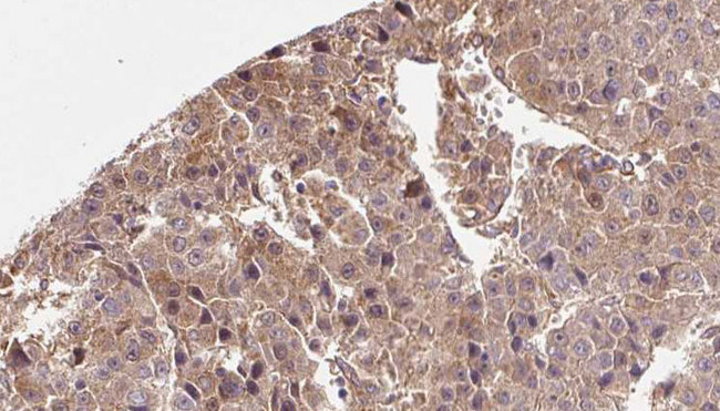 SLC2A3 / GLUT3 Antibody - 1:100 staining human liver carcinoma tissues by IHC-P. The sample was formaldehyde fixed and a heat mediated antigen retrieval step in citrate buffer was performed. The sample was then blocked and incubated with the antibody for 1.5 hours at 22°C. An HRP conjugated goat anti-rabbit antibody was used as the secondary.