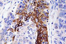 SLC2A4 / GLUT-4 Antibody - Immunohistochemistry analysis of Glut4 antibody in paraffin-embedded human lung carcinoma tissue.