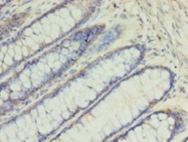 SLC2A4 / GLUT-4 Antibody - Immunohistochemistry of paraffin-embedded human rectal cancer using antibody at 1: 100 dilution.  This image was taken for the unconjugated form of this product. Other forms have not been tested.