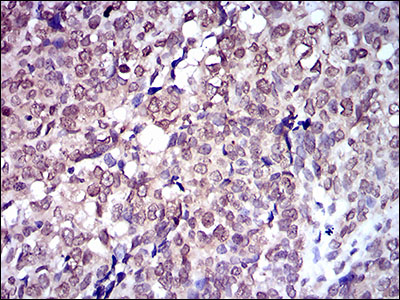SLC2A4 / GLUT-4 Antibody - IHC of paraffin-embedded bladder cancer tissues using SLC2A4 mouse monoclonal antibody with DAB staining.