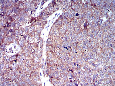 SLC2A4 / GLUT-4 Antibody - IHC of paraffin-embedded bladder cancer tissues using SLC2A4 mouse monoclonal antibody with DAB staining.