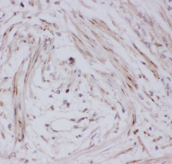 SLC2A4 / GLUT-4 Antibody - GLUT4 antibody IHC-paraffin: Human Intestinal Cancer Tissue.
