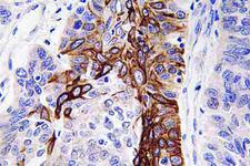 SLC2A4 / GLUT-4 Antibody - IHC of Glut4 (R271) pAb in paraffin-embedded human lung carcinoma tissue.