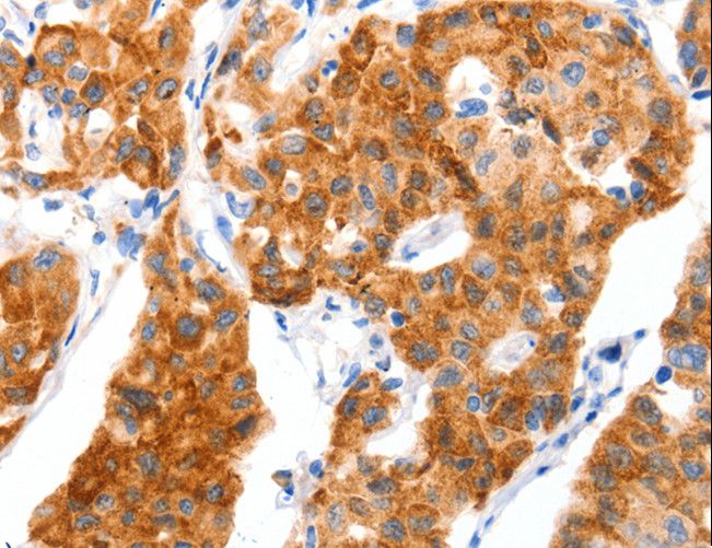 SLC2A4 / GLUT-4 Antibody - Immunohistochemistry of paraffin-embedded Human colon cancer using SLC2A4 Polyclonal Antibody at dilution of 1:70.
