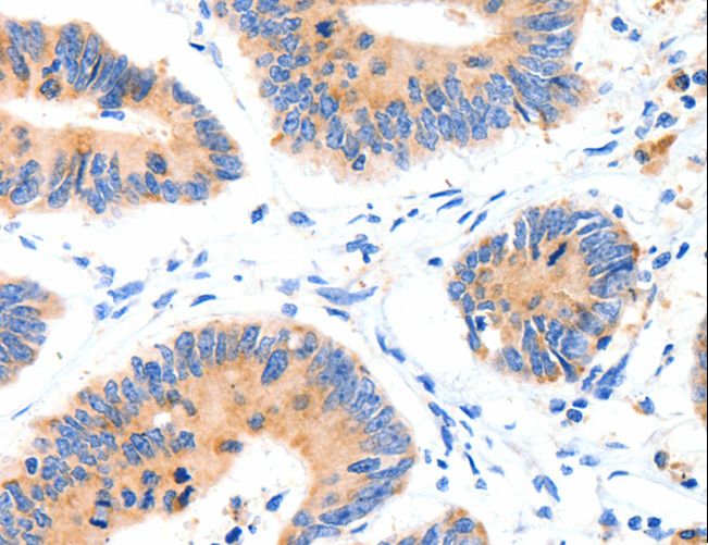 SLC2A4 / GLUT-4 Antibody - Immunohistochemistry of paraffin-embedded Human colon cancer using SLC2A4 Polyclonal Antibody at dilution of 1:70.