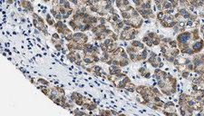 SLC2A4 / GLUT-4 Antibody - 1:100 staining human liver carcinoma tissues by IHC-P. The sample was formaldehyde fixed and a heat mediated antigen retrieval step in citrate buffer was performed. The sample was then blocked and incubated with the antibody for 1.5 hours at 22°C. An HRP conjugated goat anti-rabbit antibody was used as the secondary.