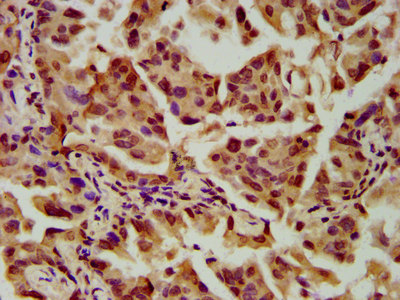 SLC2A4RG / GEF Antibody - Immunohistochemistry image at a dilution of 1:600 and staining in paraffin-embedded human lung cancer performed on a Leica BondTM system. After dewaxing and hydration, antigen retrieval was mediated by high pressure in a citrate buffer (pH 6.0) . Section was blocked with 10% normal goat serum 30min at RT. Then primary antibody (1% BSA) was incubated at 4 °C overnight. The primary is detected by a biotinylated secondary antibody and visualized using an HRP conjugated SP system.