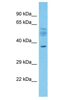 SLC2A4RG / GEF Antibody - SLC2A4RG / GEF antibody Western Blot of Esophagus Tumor. Antibody dilution: 1 ug/ml.  This image was taken for the unconjugated form of this product. Other forms have not been tested.