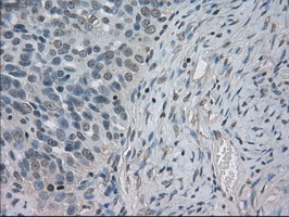 SLC2A5 / GLUT5 Antibody - IHC of paraffin-embedded Adenocarcinoma of ovary tissue using anti-SLC2A5 mouse monoclonal antibody. (Dilution 1:50).
