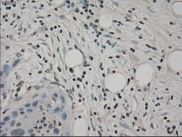 SLC2A5 / GLUT5 Antibody - IHC of paraffin-embedded Carcinoma of pancreas tissue using anti-SLC2A5 mouse monoclonal antibody. (Dilution 1:50).