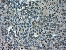 SLC2A5 / GLUT5 Antibody - Immunohistochemical staining of paraffin-embedded Adenocarcinoma of ovary tissue using anti-SLC2A5 mouse monoclonal antibody. (Dilution 1:50).