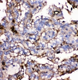 SLC2A9 / GLUT9 Antibody - IHC analysis of GLUT9 using anti-GLUT9 antibody. GLUT9 was detected in paraffin-embedded section of human renal cancer tissues. Heat mediated antigen retrieval was performed in citrate buffer (pH6, epitope retrieval solution) for 20 mins. The tissue section was blocked with 10% goat serum. The tissue section was then incubated with 1µg/ml rabbit anti-GLUT9 Antibody overnight at 4°C. Biotinylated goat anti-rabbit IgG was used as secondary antibody and incubated for 30 minutes at 37°C. The tissue section was developed using Strepavidin-Biotin-Complex (SABC) with DAB as the chromogen.