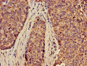 SLC2A9 / GLUT9 Antibody - Immunohistochemistry of paraffin-embedded human ovarian cancer using SLC2A9 Antibody at dilution of 1:100