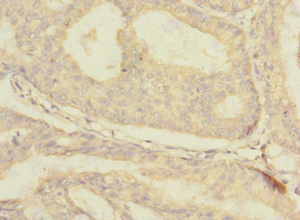 SLC30A1 / ZNT1 Antibody - Immunohistochemistry of paraffin-embedded human endometrial cancer at dilution 1:100