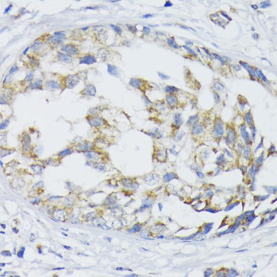 SLC30A1 / ZNT1 Antibody - Immunohistochemistry of paraffin-embedded Human mammary cancer using SLC30A1 Polyclonal Antibody at dilution of 1:100 (40x lens).