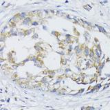 SLC30A1 / ZNT1 Antibody - Immunohistochemistry of paraffin-embedded Human mammary cancer using SLC30A1 Polyclonal Antibody at dilution of 1:100 (40x lens).