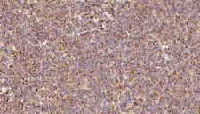 SLC30A3 / ZNT3 Antibody - 1:100 staining human lymph carcinoma tissue by IHC-P. The sample was formaldehyde fixed and a heat mediated antigen retrieval step in citrate buffer was performed. The sample was then blocked and incubated with the antibody for 1.5 hours at 22°C. An HRP conjugated goat anti-rabbit antibody was used as the secondary.