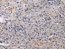 SLC30A3 / ZNT3 Antibody - Immunohistochemistry of paraffin-embedded Human brain tissue  using SLC30A3 Polyclonal Antibody at dilution of 1:55(×200)