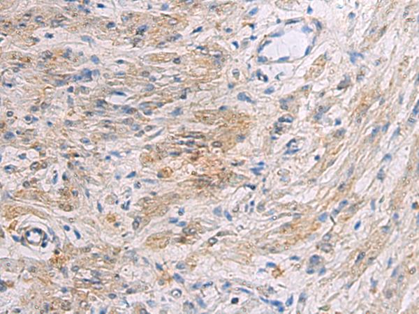 SLC30A3 / ZNT3 Antibody - Immunohistochemistry of paraffin-embedded Human gastric cancer tissue  using SLC30A3 Polyclonal Antibody at dilution of 1:55(×200)