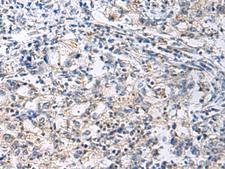 SLC30A3 / ZNT3 Antibody - Immunohistochemistry of paraffin-embedded Human gastric cancer tissue  using SLC30A3 Polyclonal Antibody at dilution of 1:70(×200)