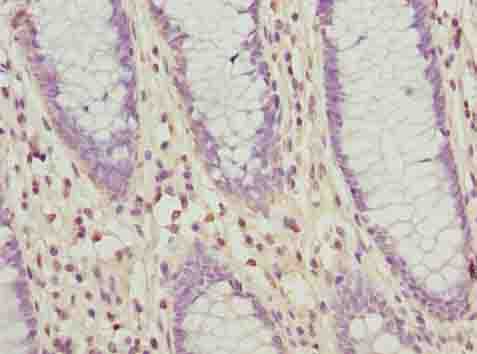 SLC30A6 Antibody - Immunohistochemistry of paraffin-embedded human colon cancer using antibody at dilution of 1:100.