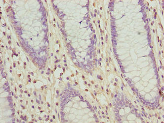 SLC30A6 Antibody - Immunohistochemistry of paraffin-embedded human colon cancer using SLC30A6 Antibody at dilution of 1:100