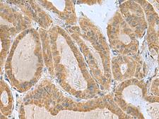 SLC30A6 Antibody - Immunohistochemistry of paraffin-embedded Human thyroid cancer tissue  using SLC30A6 Polyclonal Antibody at dilution of 1:75(×200)