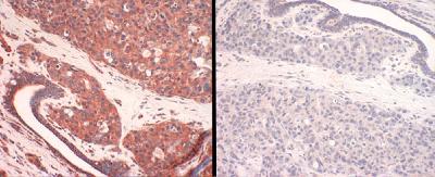 SLC31A1 / CTR1 Antibody - Panel 1: human CTR1 staining of breast cancer tissue. Panel 2: human CTR1-antigen competition in breast cancer tissue.  This image was taken for the unconjugated form of this product. Other forms have not been tested.