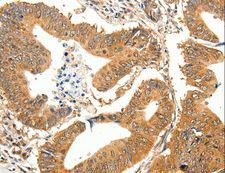 SLC32A1 / VGAT Antibody - Immunohistochemistry of paraffin-embedded Human colon cancer using SLC32A1 Polyclonal Antibody at dilution of 1:35.