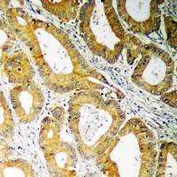 SLC32A1 / VGAT Antibody - Immunohistochemical analysis of VGAT staining in human colon cancer formalin fixed paraffin embedded tissue section. The section was pre-treated using heat mediated antigen retrieval with sodium citrate buffer (pH 6.0). The section was then incubated with the antibody at room temperature and detected using an HRP conjugated compact polymer system. DAB was used as the chromogen. The section was then counterstained with hematoxylin and mounted with DPX.